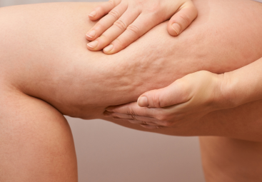Cellulite bekeken vanuit 3 perspectieven: westerse geneeskunde, TCM en Ayurveda
